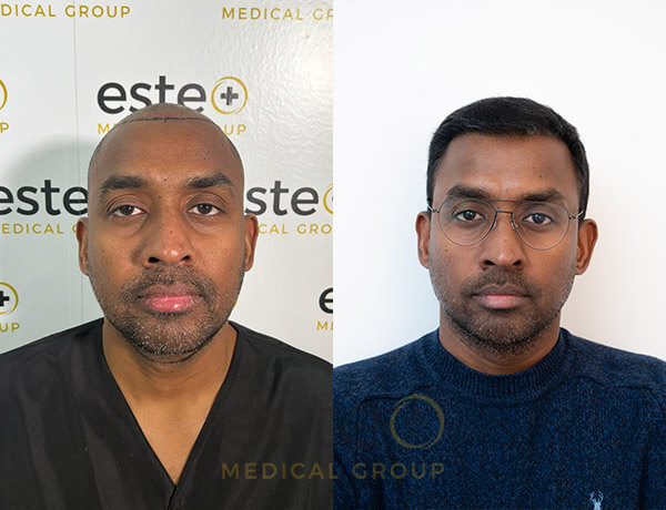 Hair transplant before and after Leeds