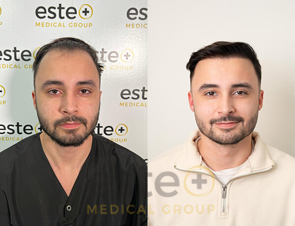Hair transplant before and after Leeds