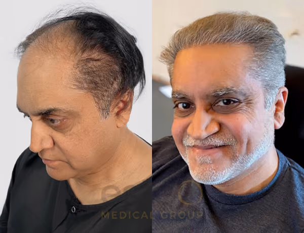 Hair transplant before and after Leeds