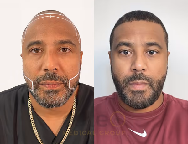 Hair transplant before and after Leeds