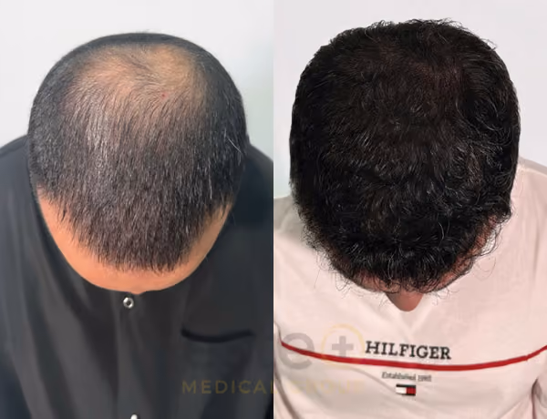 Hair transplant before and after Leeds