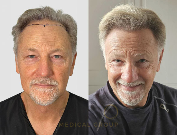 Hair transplant before and after Leeds