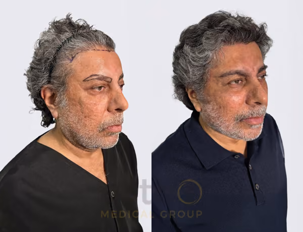Hair transplant before and after Leeds