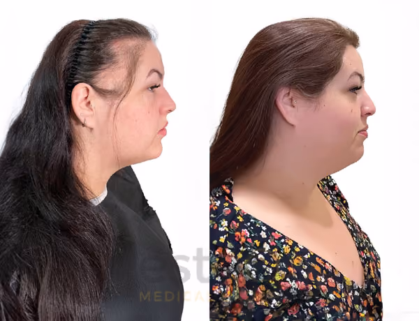 Hair transplant before and after Leeds