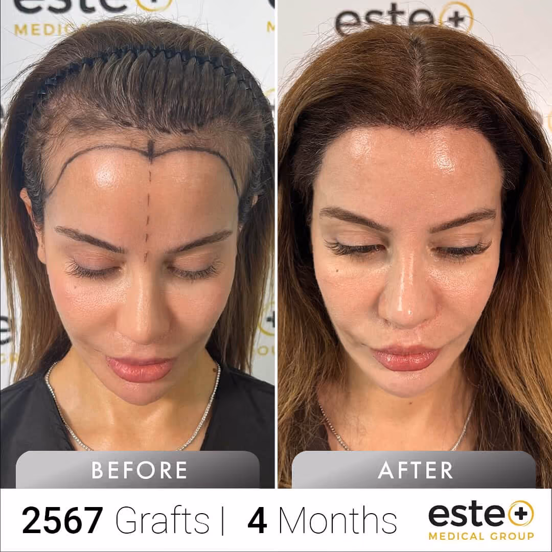 FUE Hair Transplant Before & After