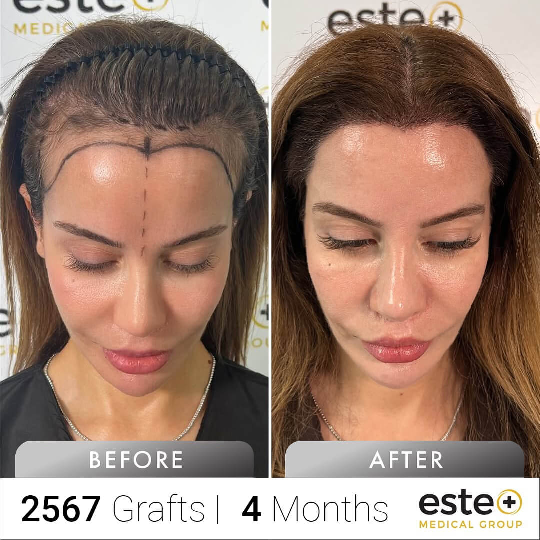 FUE Hair Transplant Before & After