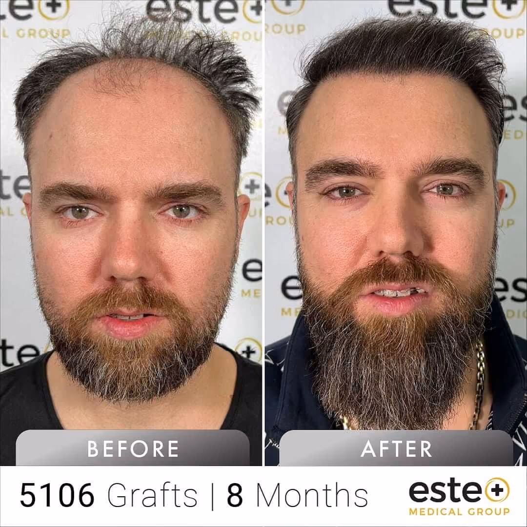 FUE Hair Transplant Before & After