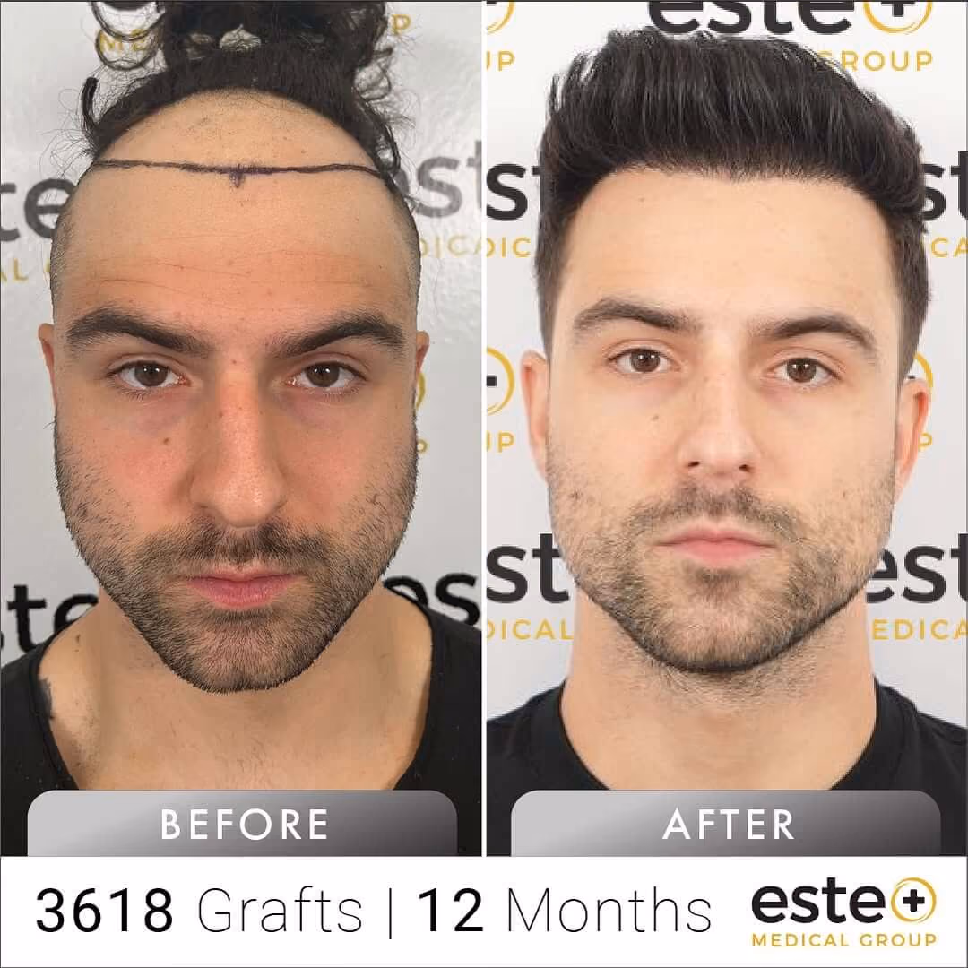FUE Hair Transplant Before & After