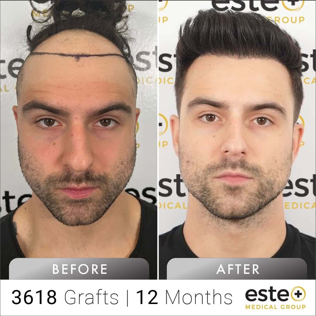 FUE Hair Transplant Before & After