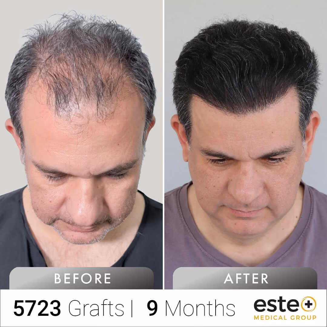 FUE Hair Transplant Before & After