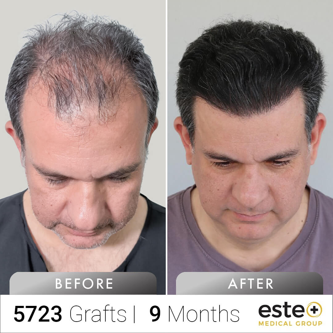 FUE Hair Transplant Before & After