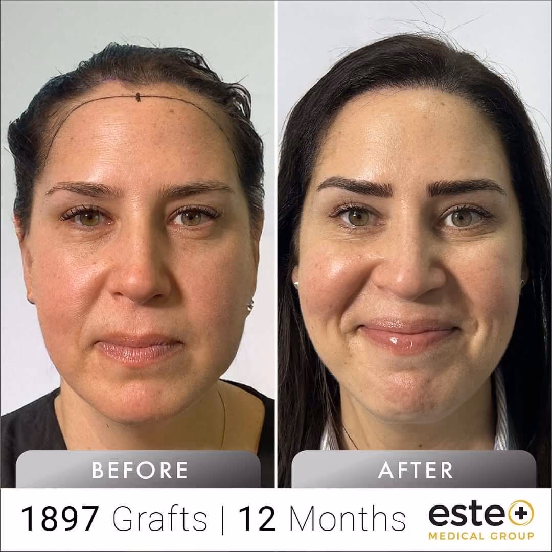 female_Before and after images