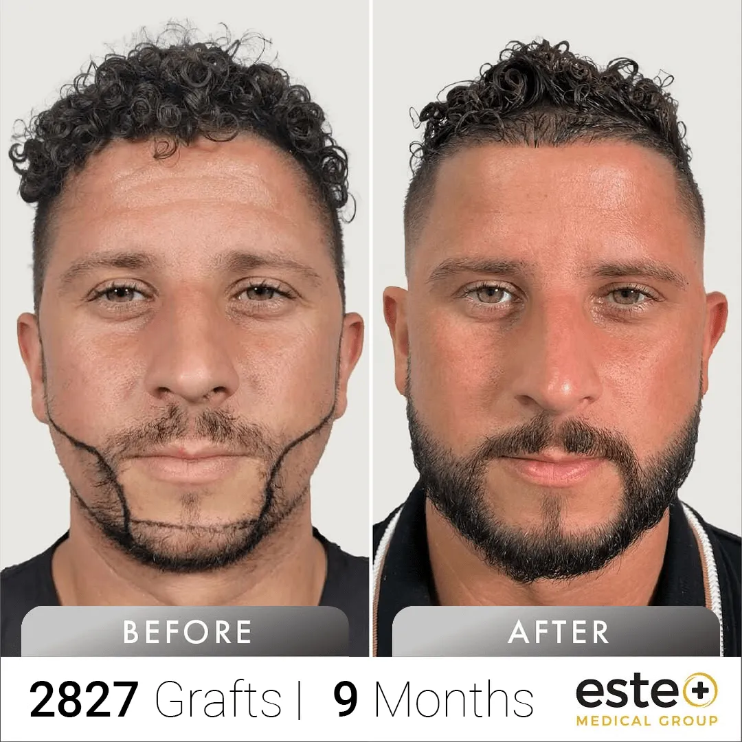 Beard_Before and after images