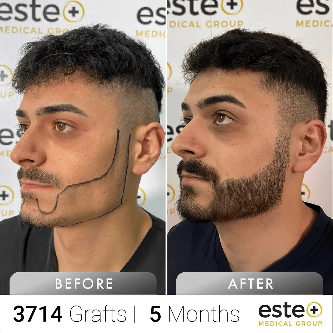 Beard_Before and after images