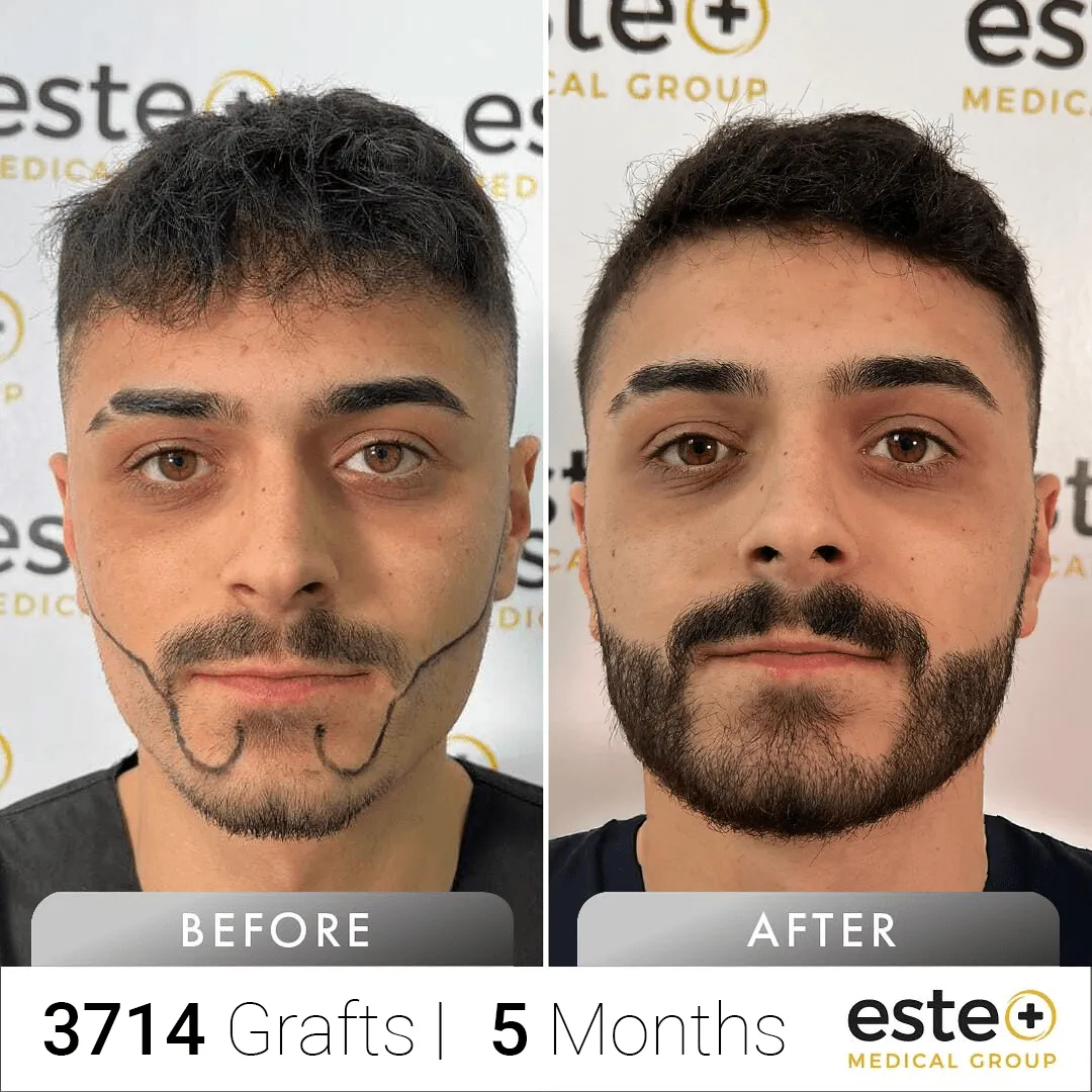 Beard_Before and after images