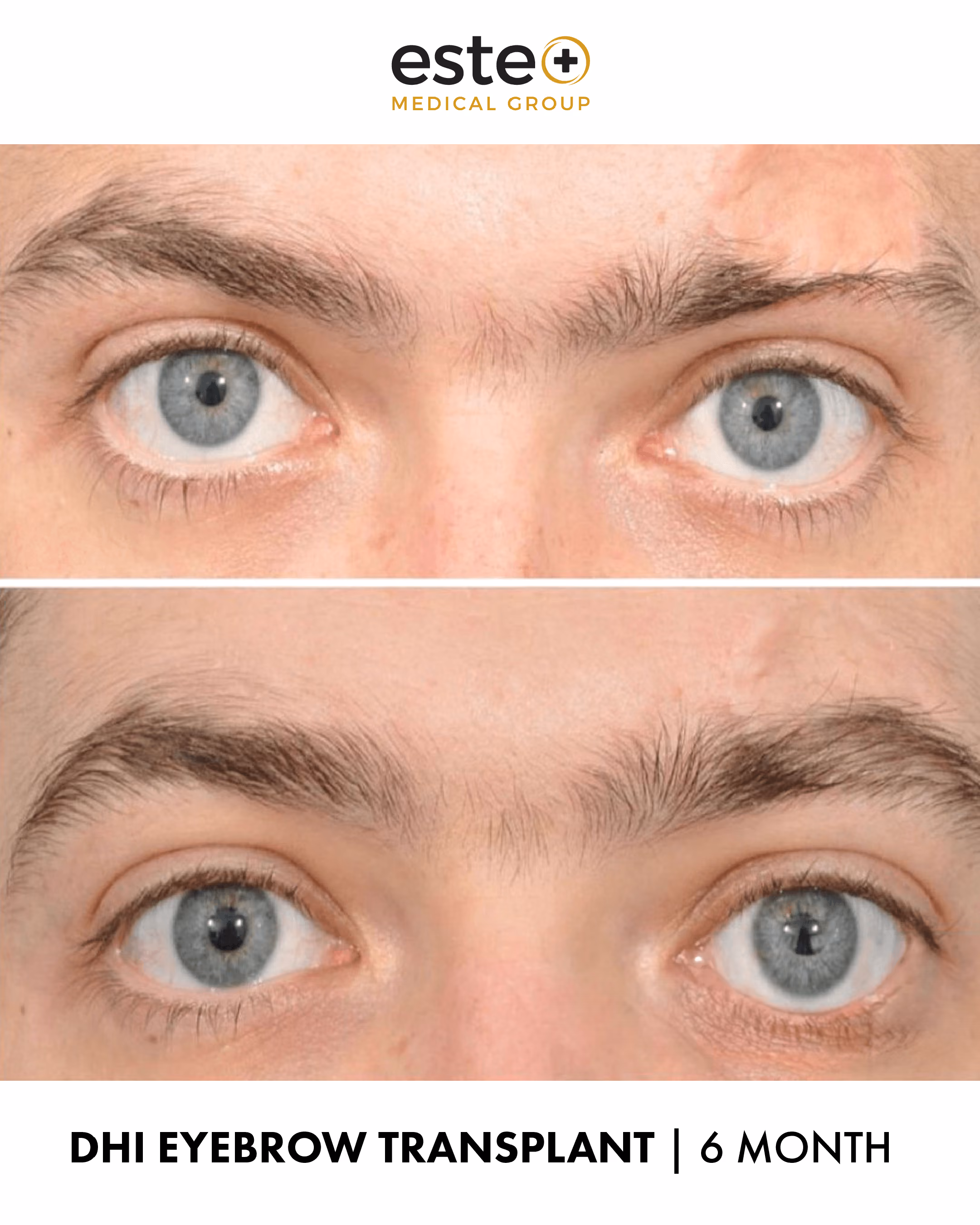 eyebrow_Before and after images