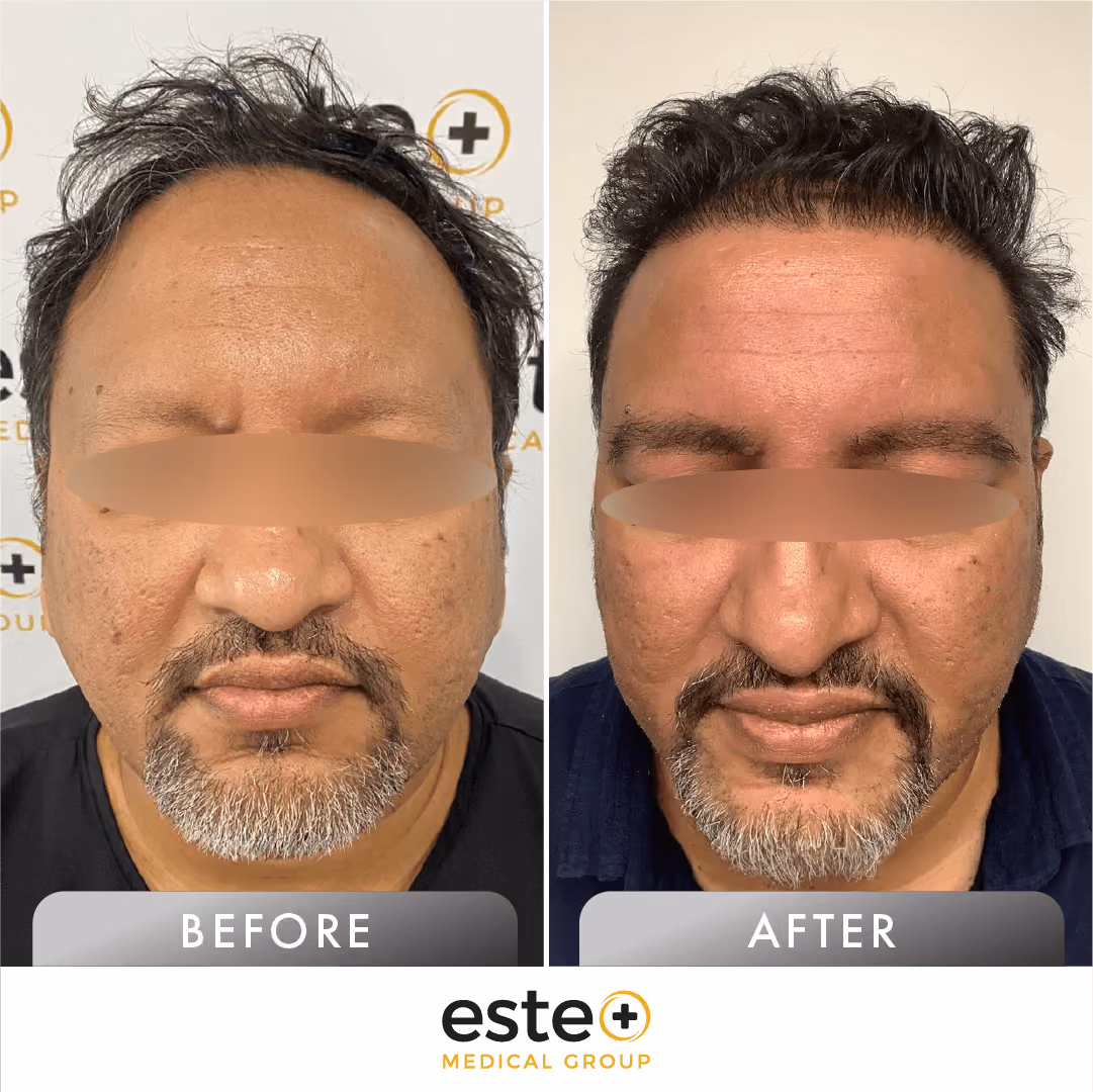 eyebrow_Before and after images