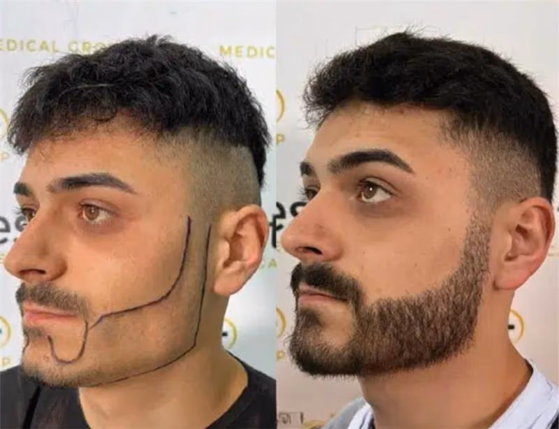 Beard Transplant _ Este Medical Group
