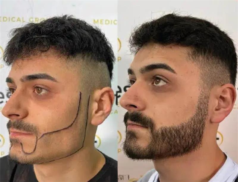 Beard Transplant _ Este Medical Group