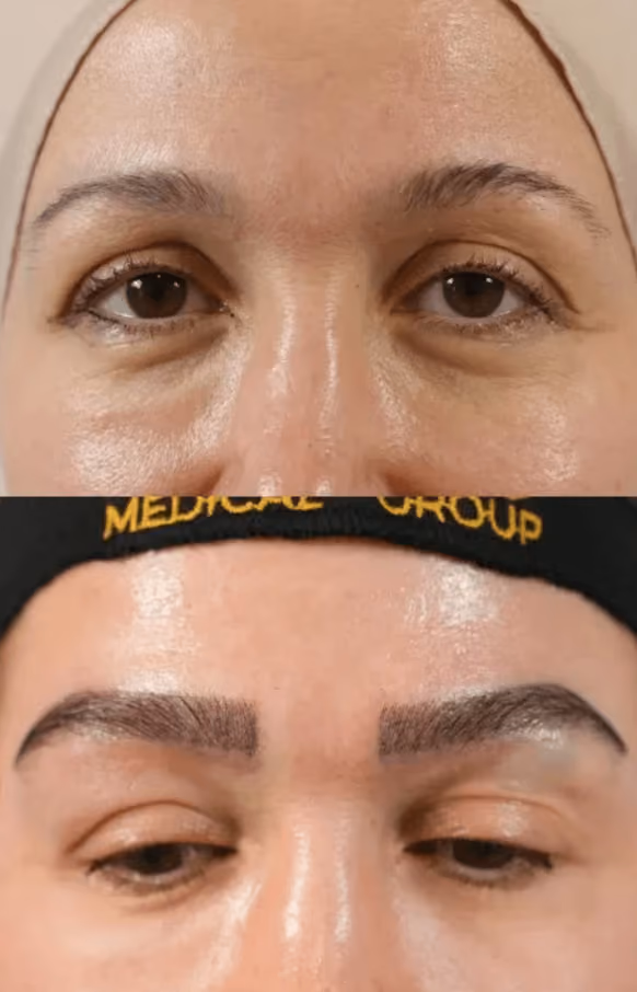 Eyebrow Transplant _ Este Medical Group