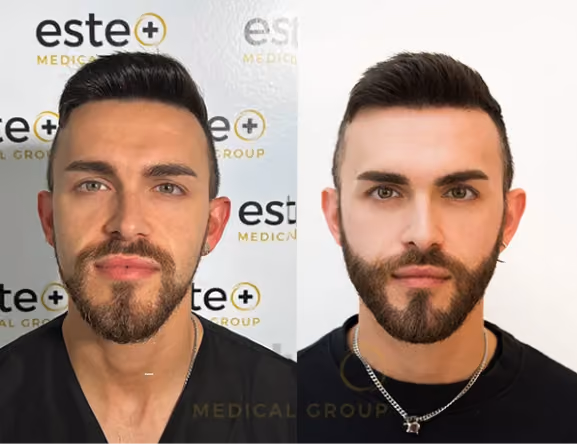 Beard Transplant _ Este Medical Group
