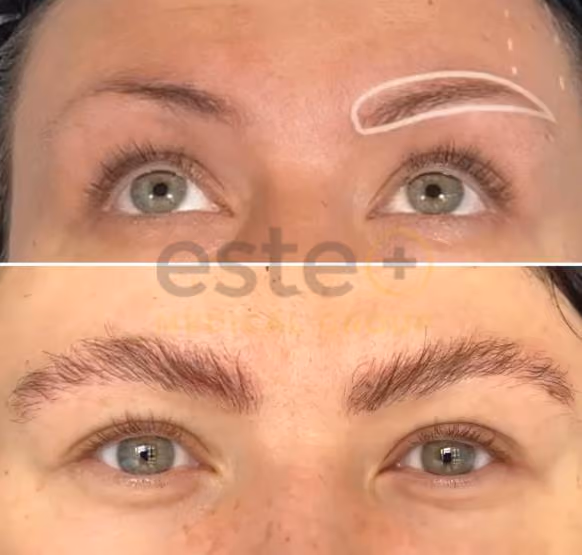 Eyebrow Transplant Turkey _ Eyebrow Transplant Istanbul - Este