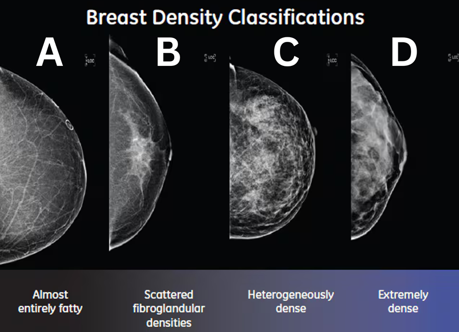 breast-density-card