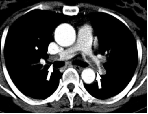 Pulmonary Embolism CT Scan 

Attribution 2.0 Generic
Deed

https://openi.nlm.nih.gov/detailedresult?img=PMC2020460_1476-7120-5-26-3&query=pulmonary%20embolism&it=xg&lic=by&req=4&npos=6