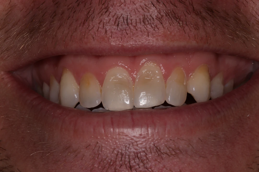 before and after treatment