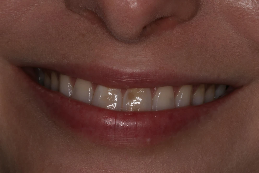 before and after treatment