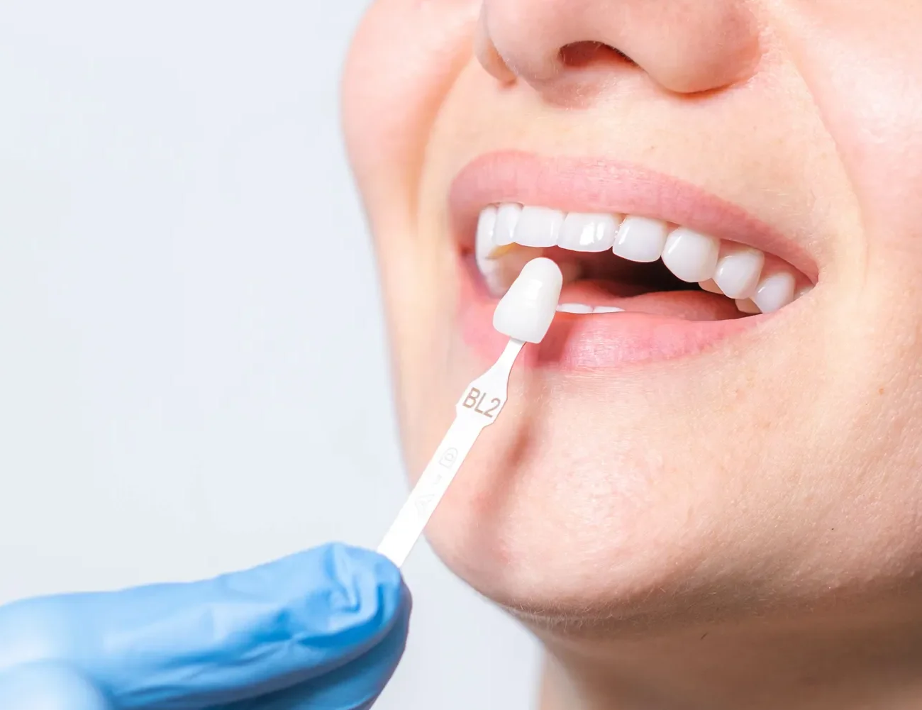 Porcelain veneer shade guide held beside a patient’s smile.