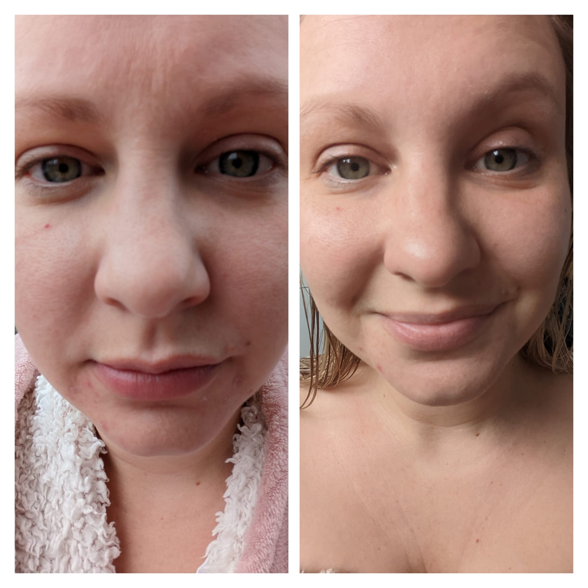 Emma before & after skincare - front of face