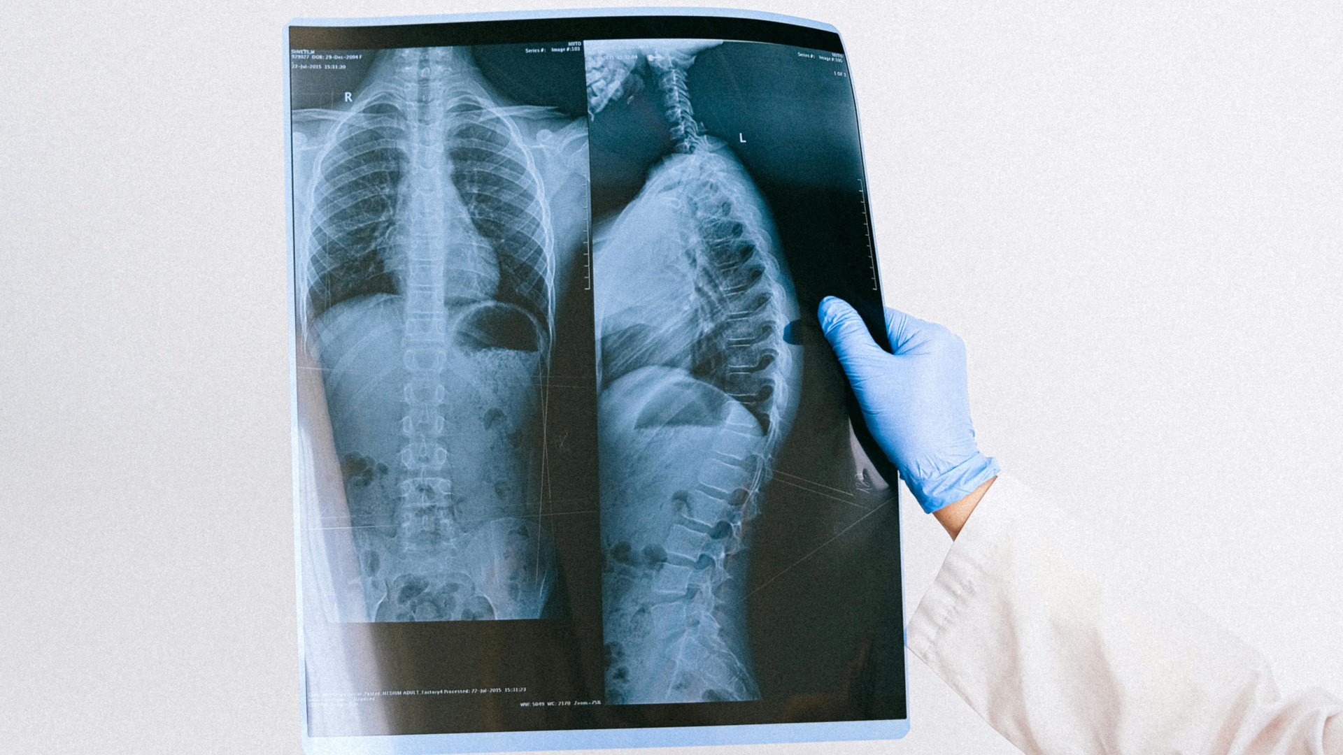 An image of the back and spine xray