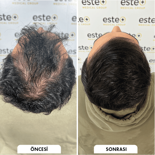 Hair transplant before and after Leeds