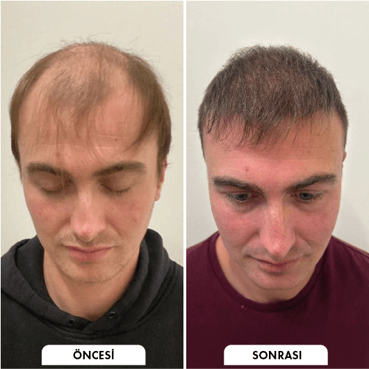 Hair transplant before and after Leeds