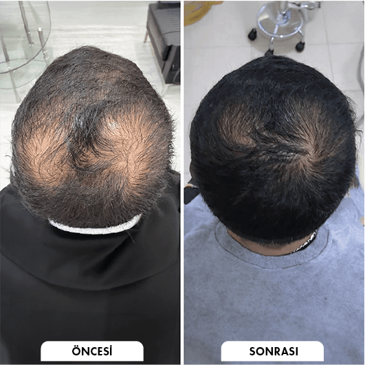 Hair transplant before and after Leeds