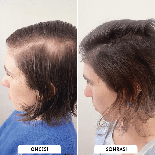 Hair transplant before and after Leeds