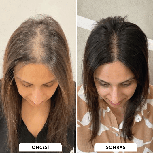 Hair transplant before and after Leeds