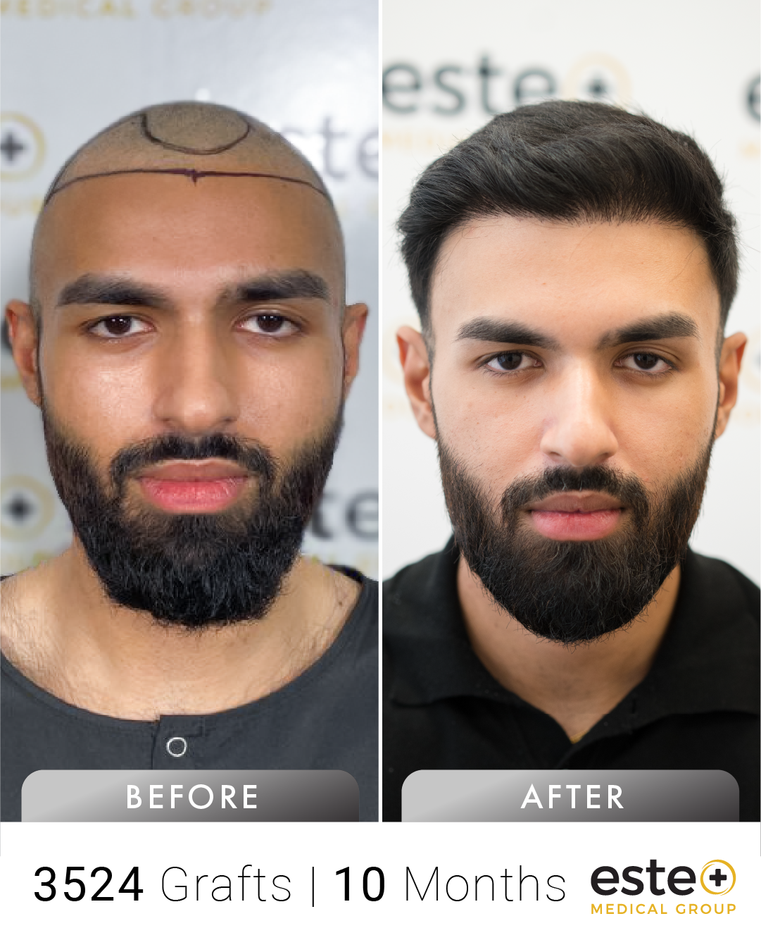 Sam saç ekimi before after sonucu – Este Medical İstanbul