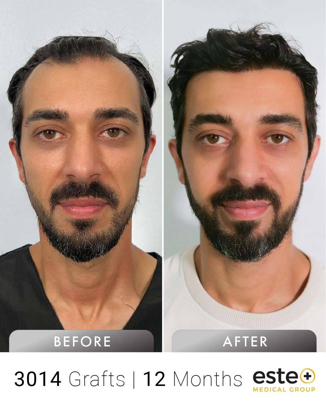 Erkan saç ekimi before after sonucu – Este Medical İstanbul