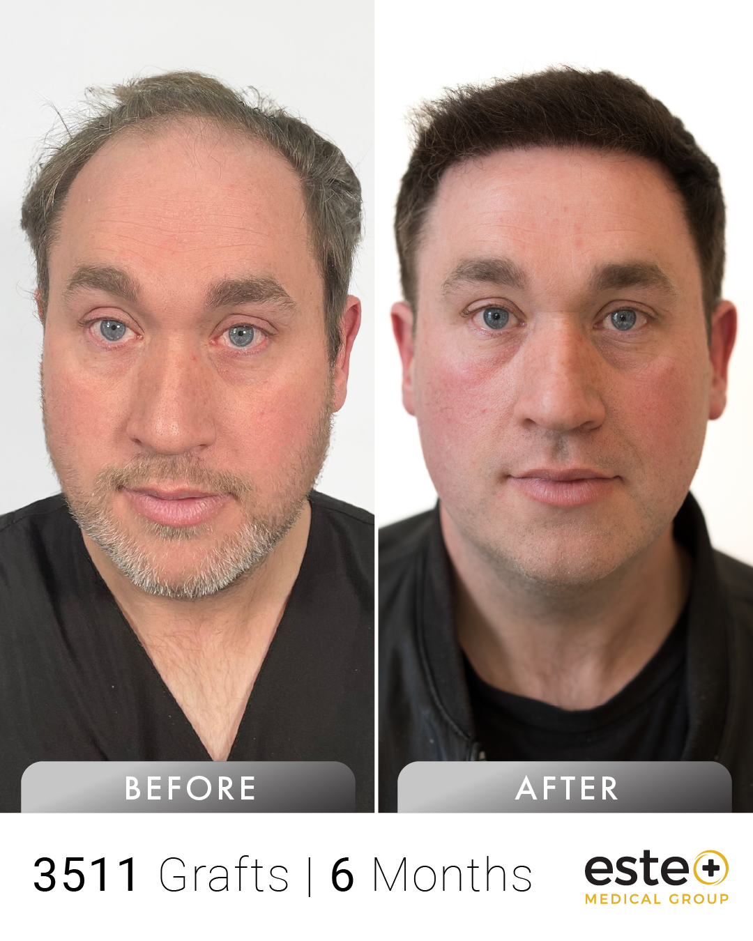 Craig saç ekimi before after sonucu – Este Medical İstanbul