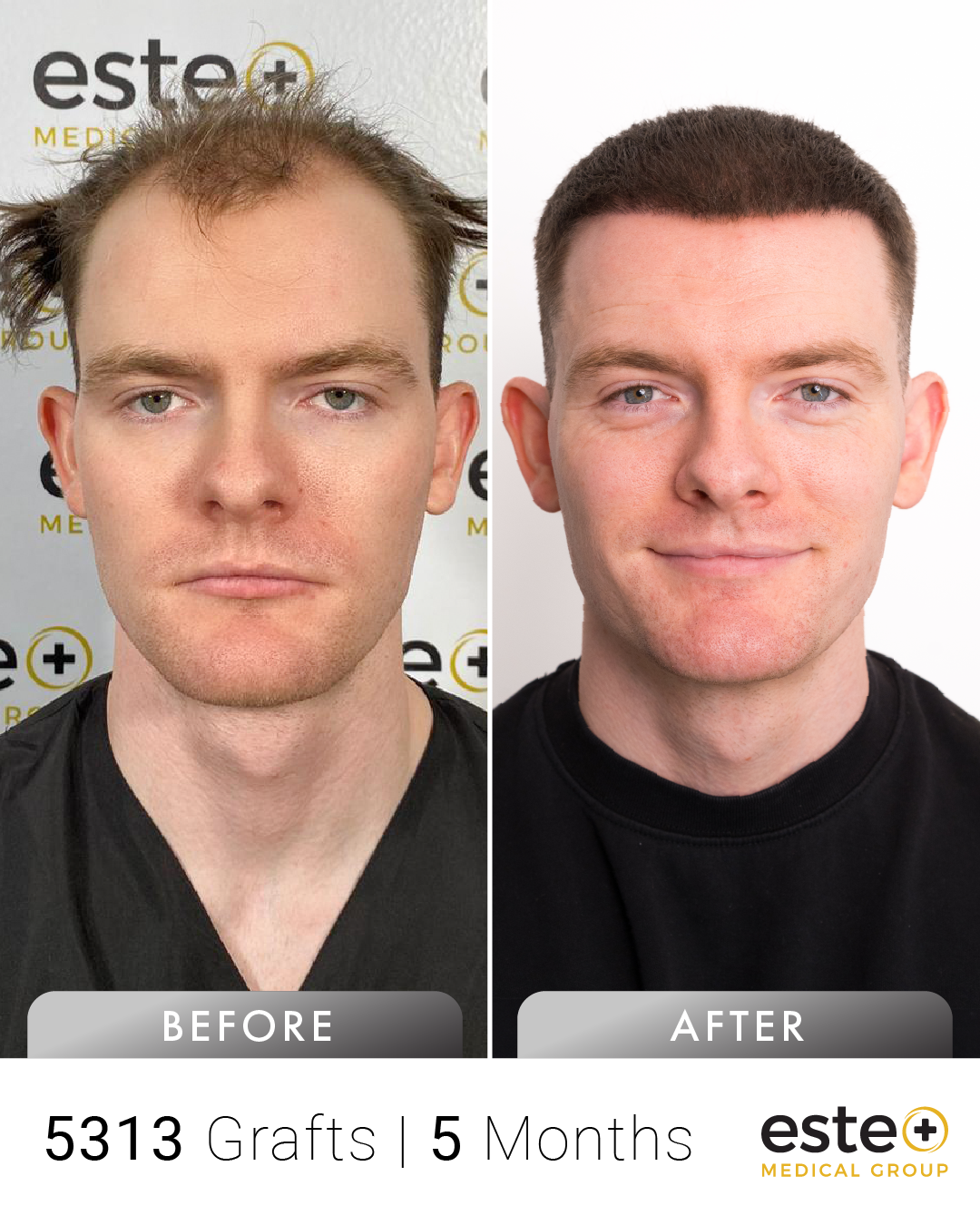 Mathew saç ekimi before after sonucu – Este Medical İstanbul