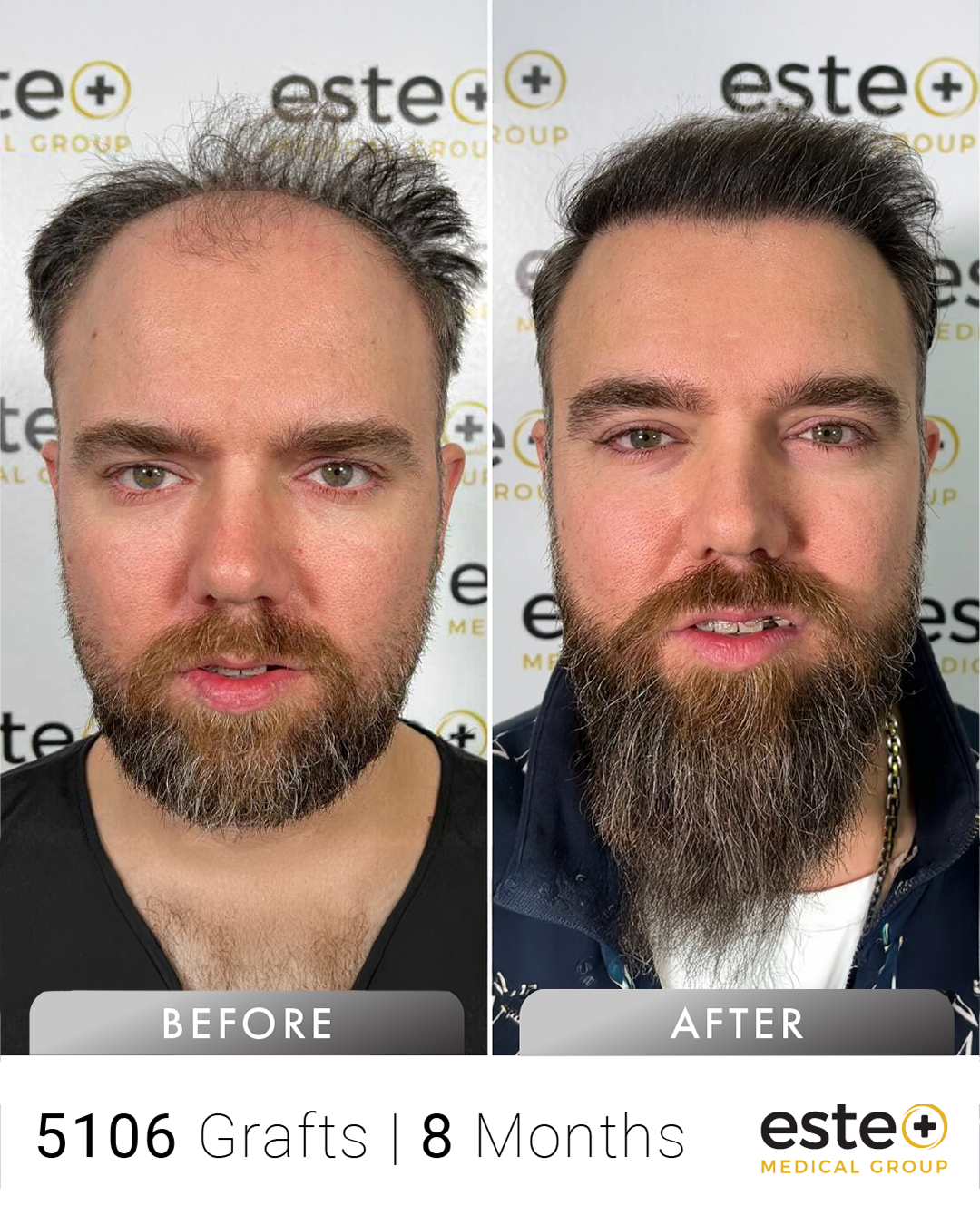 Ergun saç ekimi before after sonucu – Este Medical İstanbul