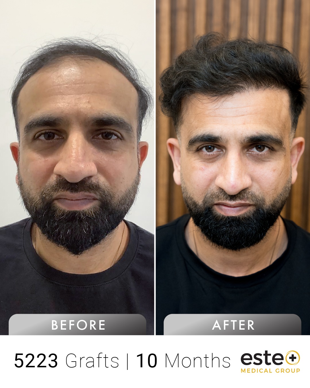 Mohsin saç ekimi before after sonucu – Este Medical İstanbul