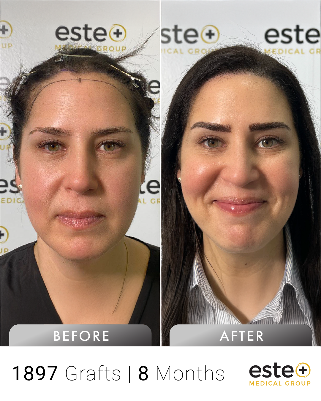 Heather kadın saç ekimi before after sonucu – Este Medical İstanbul