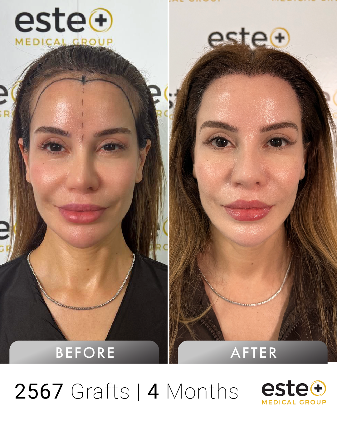 Başak kadın saç ekimi before after sonucu – Este Medical İstanbul