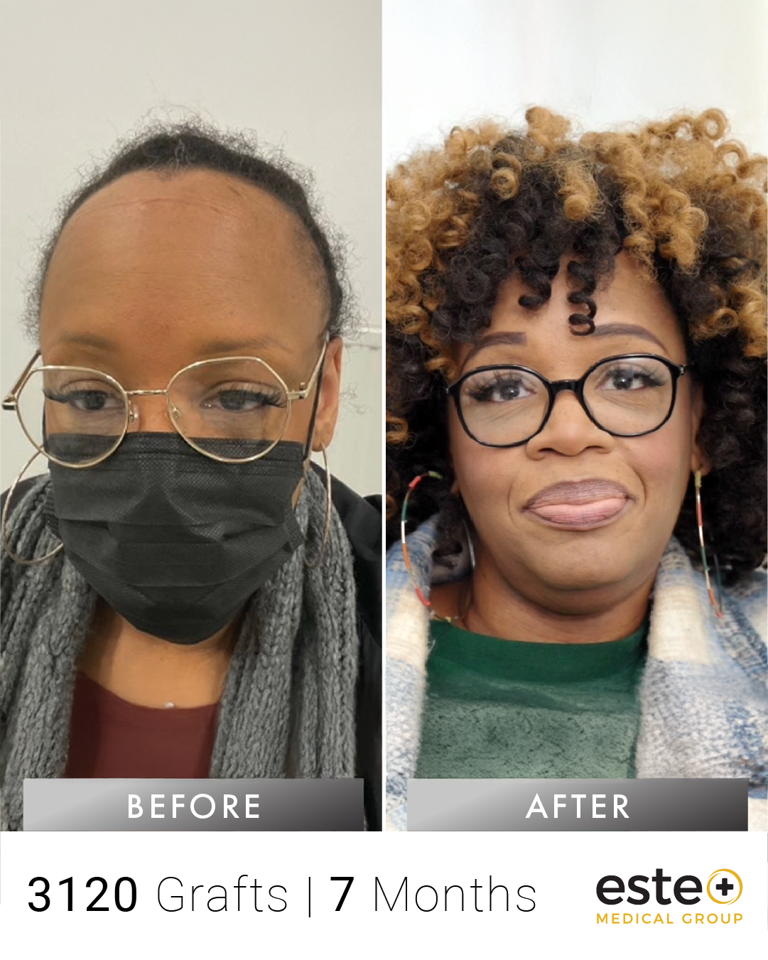 Mary kadın saç ekimi before after sonucu – Este Medical İstanbul
