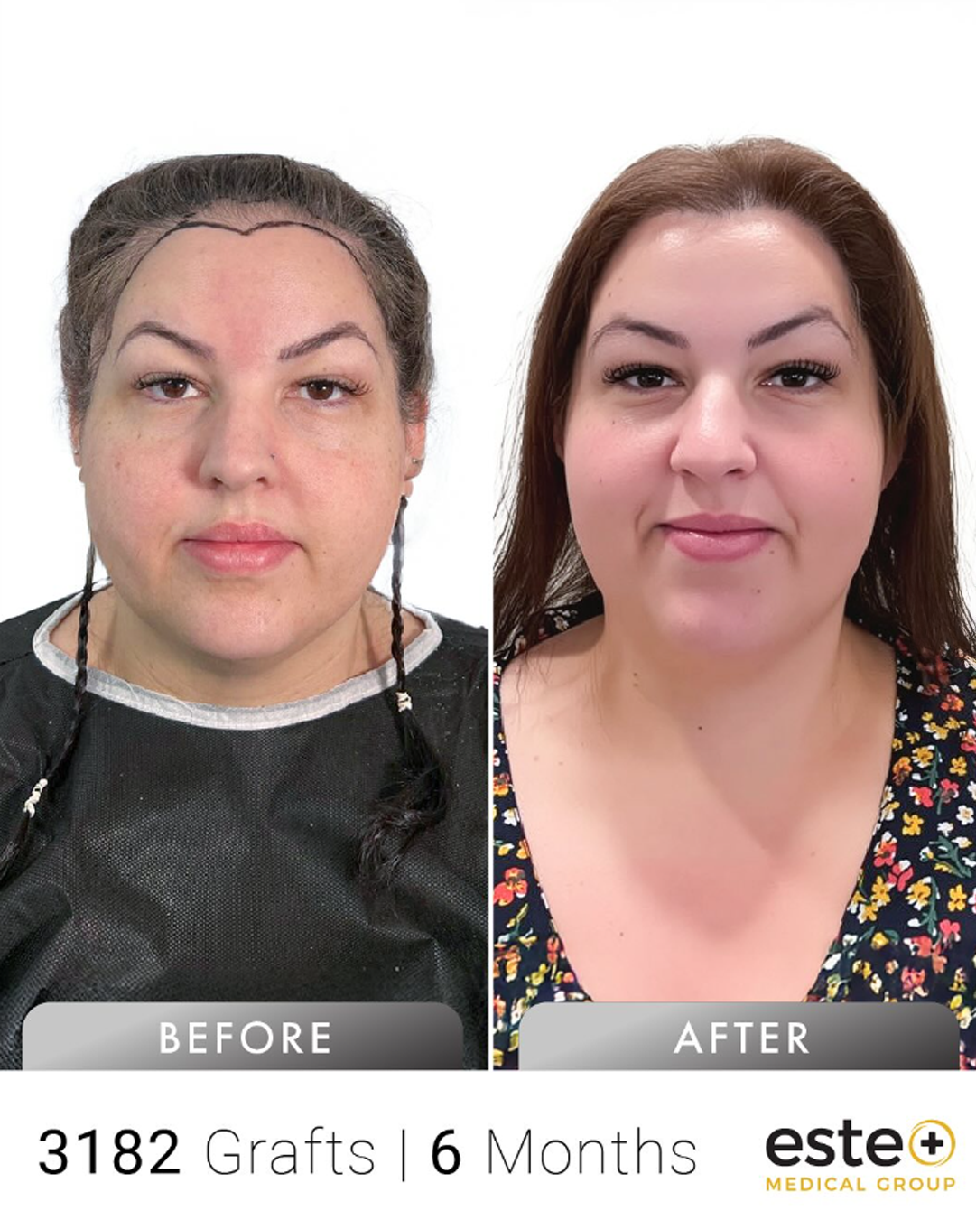 Jes kadın saç ekimi before after sonucu – Este Medical İstanbul