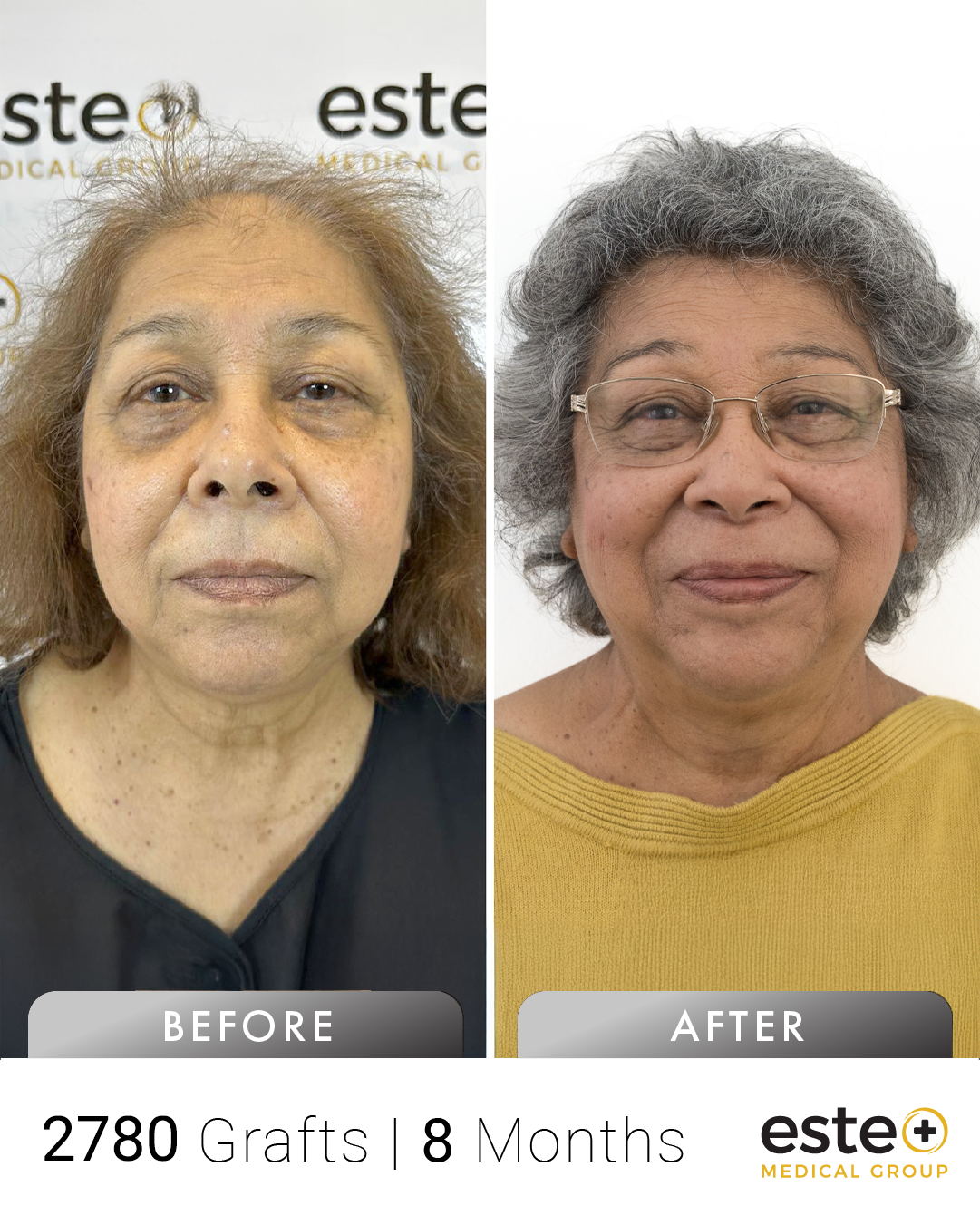 An kadın saç ekimi before after sonucu – Este Medical İstanbul