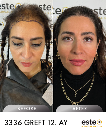 saç ekimi öncesi sonrası